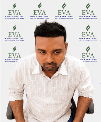 After hair transplant result 11